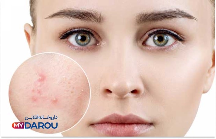 بهترین کرم ضد جوش قوی 